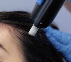 MESOTERAPIA CAPILAR